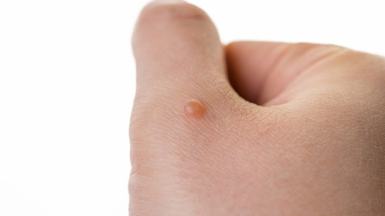 Néophages sur le bras