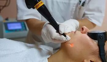 Une procédure efficace pour éliminer les papillomes sur le visage à l'aide d'un laser