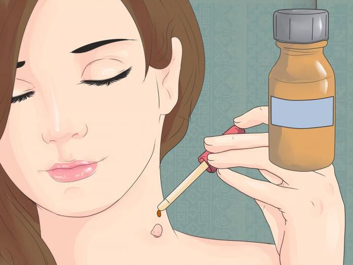 Utilisez le médicament sous forme de solution pour éliminer le papillome sur le cou