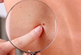 Raisons de l'apparition de papillomes sur le corps humain