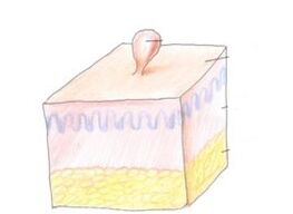 comment se débarrasser des papillomes sur le corps