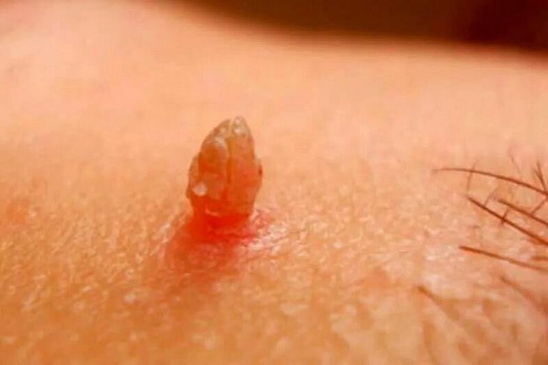 Verrues génitales sur le corps