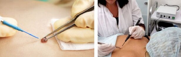 Électrocoagulation pour éliminer les papillomes