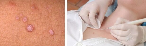 Élimination professionnelle des papillomes sur le corps