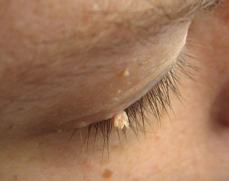 Condylome sur la paupière