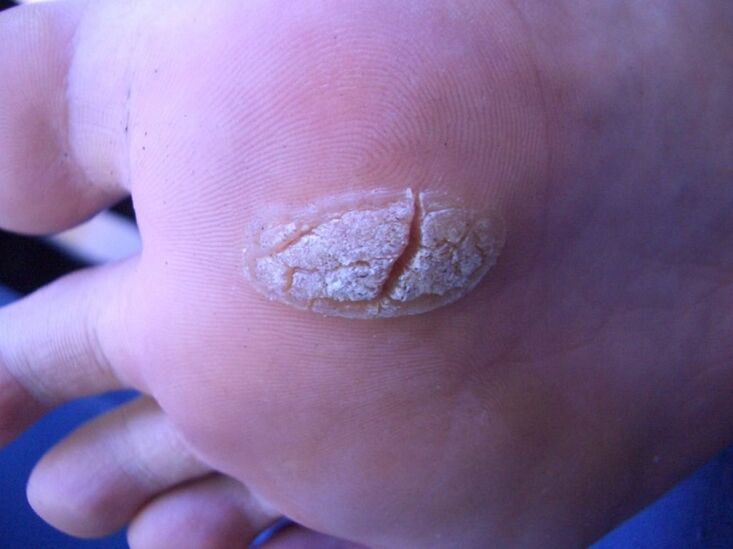 Verrue sur la peau du pied