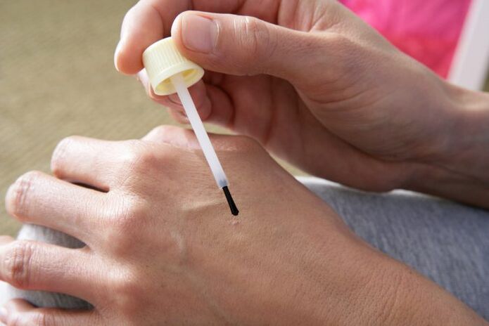 Cautériser les verrues avec du jus de chélidoine